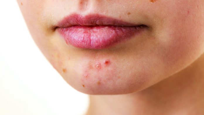 Female face with acne skin problem